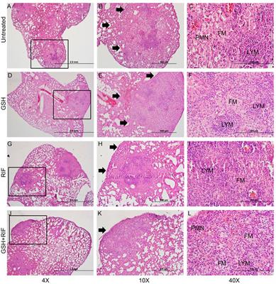 L-GSH Supplementation in Conjunction With Rifampicin Augments the Treatment Response to Mycobacterium tuberculosis in a Diabetic Mouse Model